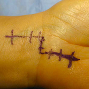 Cicatriz dejada por una cirugía abierta