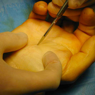 Incisión en el momento de una operación quirúrgica